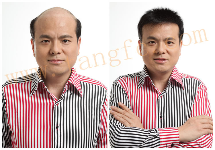 合肥織發(fā)補發(fā)去哪里好?