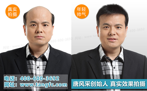 禿頂補發(fā)就選唐風采補發(fā)機構 禿頂補發(fā)就選唐風采補發(fā)機構