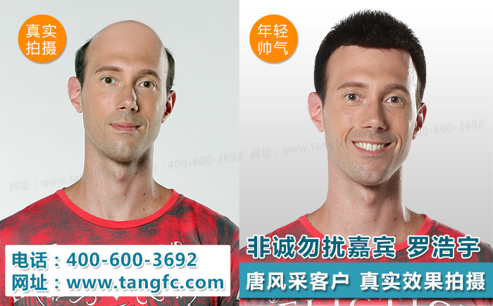 禿頂脫發(fā)怎么辦？禿頂補(bǔ)發(fā)就選唐風(fēng)采補(bǔ)發(fā)機(jī)構(gòu)