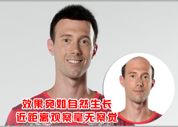 禿發(fā)可以補發(fā)嗎？補發(fā)會掉嗎？
