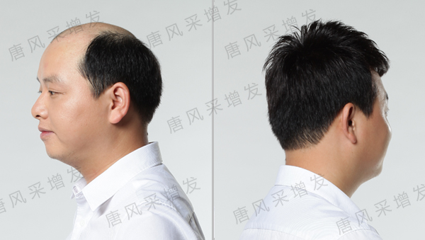 脫發(fā)后怎么辦？脫發(fā)補(bǔ)發(fā)也許是你最好的選擇！