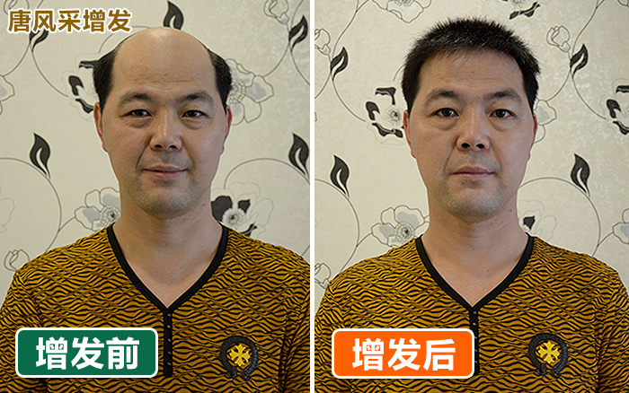 唐風(fēng)采堅持做好一件事！拉薩男士補發(fā)哪里好？