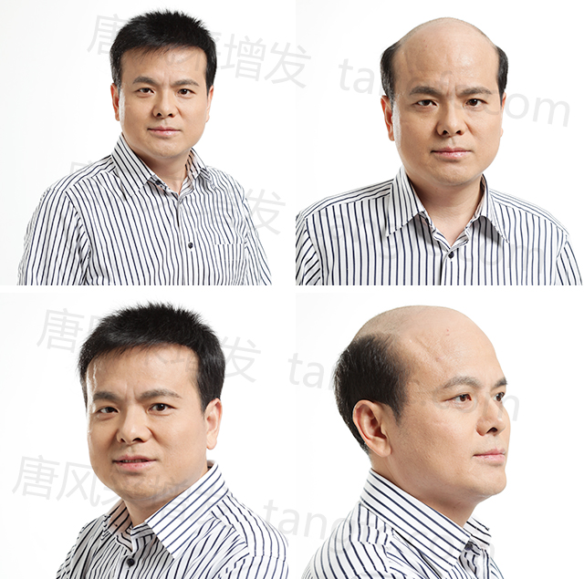 合肥頭發(fā)稀少長(zhǎng)時(shí)間脫發(fā)，有管用的解決方法嗎？