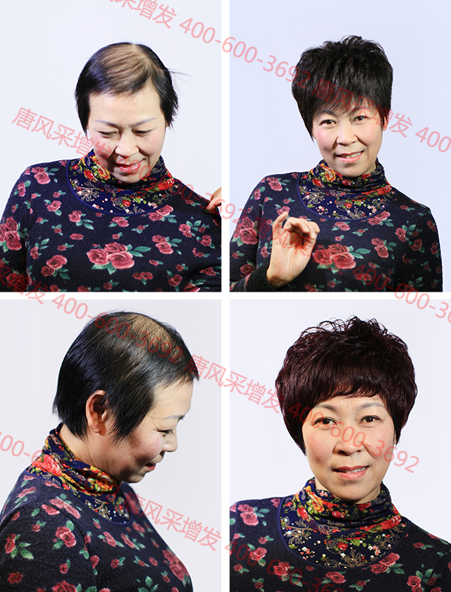 合肥織發(fā)定制解決脫發(fā)，什么品牌值得信賴？