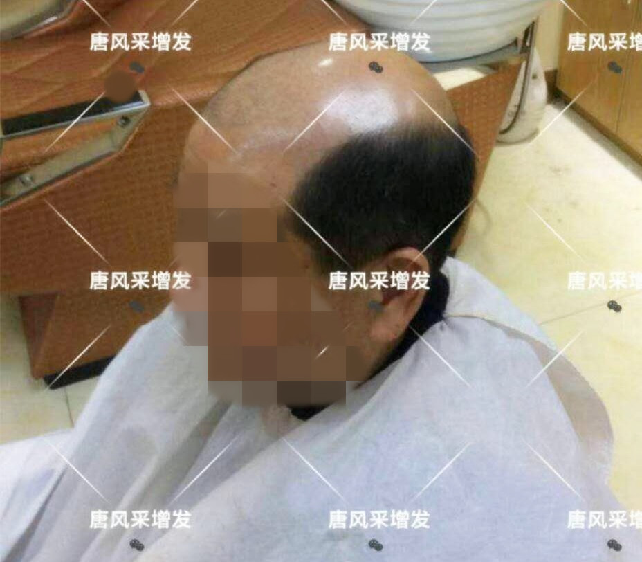 男人脫發(fā)原因多，不能一味怨腎虧！