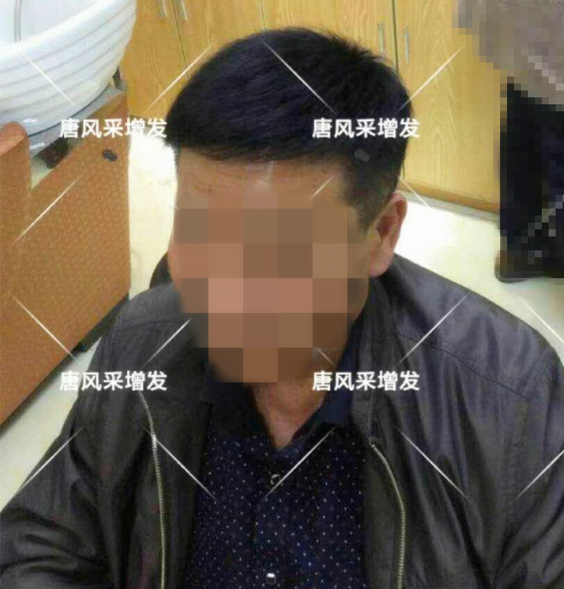 男人脫發(fā)原因多，不能一味怨腎虧！