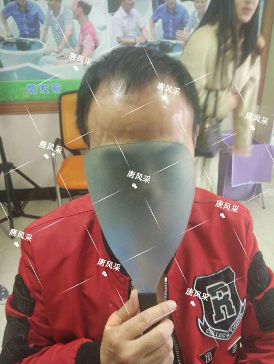 男人脫發(fā)原因多，不能一味怨腎虧！
