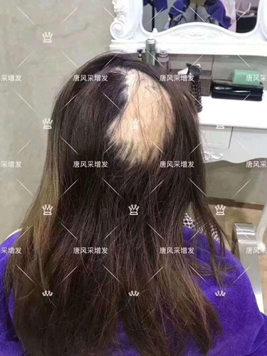 西寧織發(fā)補發(fā)需要多少錢,哪家補發(fā)技術(shù)好？