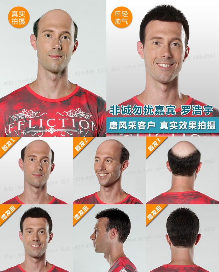 唐風采隱形無痕增發(fā)