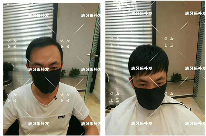男士禿頂了 唐風(fēng)采客戶案例