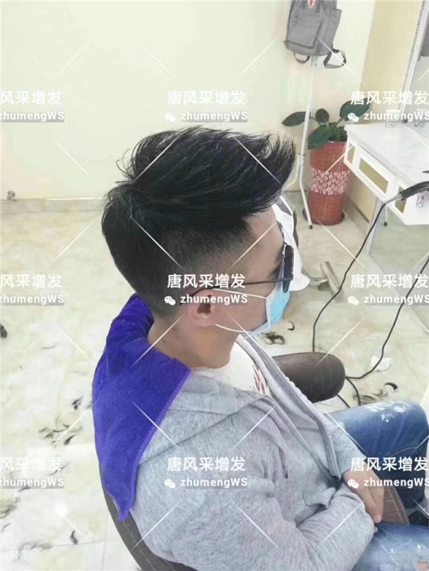 男士真發(fā)補發(fā)塊 唐風(fēng)采客戶案例小唐增發(fā)后
