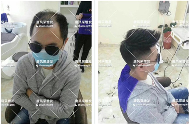 男士真發(fā)補發(fā)塊 唐風(fēng)采客戶案例小唐增發(fā)后