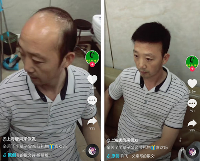 頭頂局部假發(fā) 唐風采客戶案例