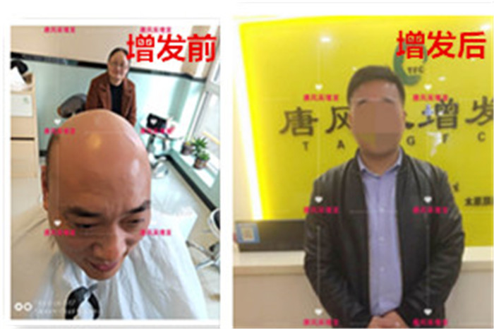 禿頂改造 唐風(fēng)采客戶