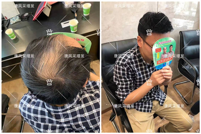 自然織發(fā)補發(fā)效果 \