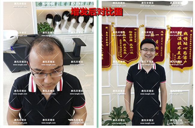 織發(fā)補發(fā)效果 \