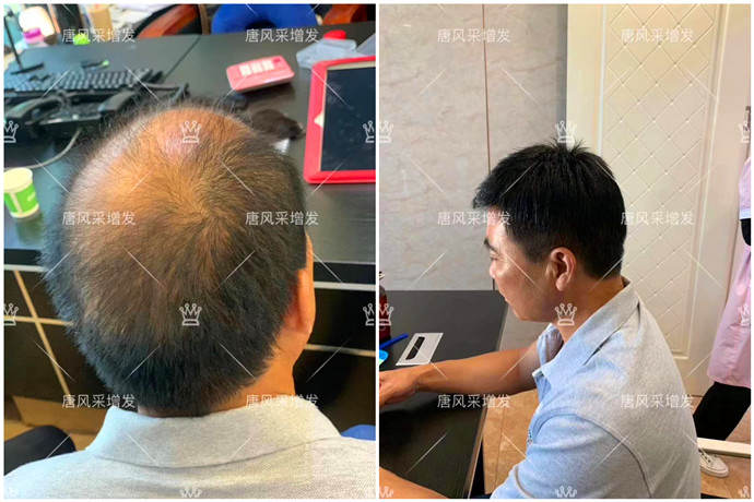 長期戴假發(fā) \