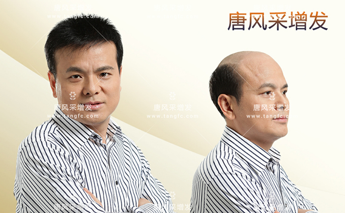 脫發(fā)人的中年危機(jī) \