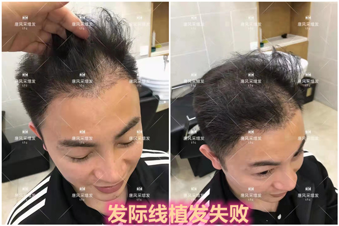 男士隱形補(bǔ)發(fā)哪家好 \
