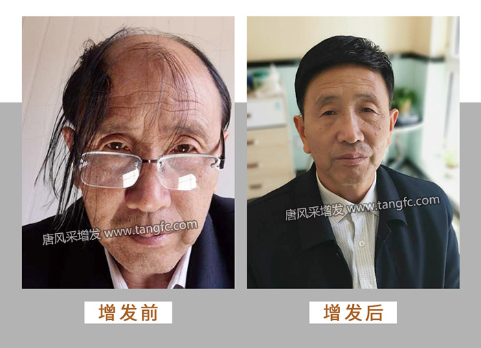 唐風采定制局部假發(fā) \