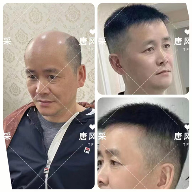 仿生長無痕假發(fā) \