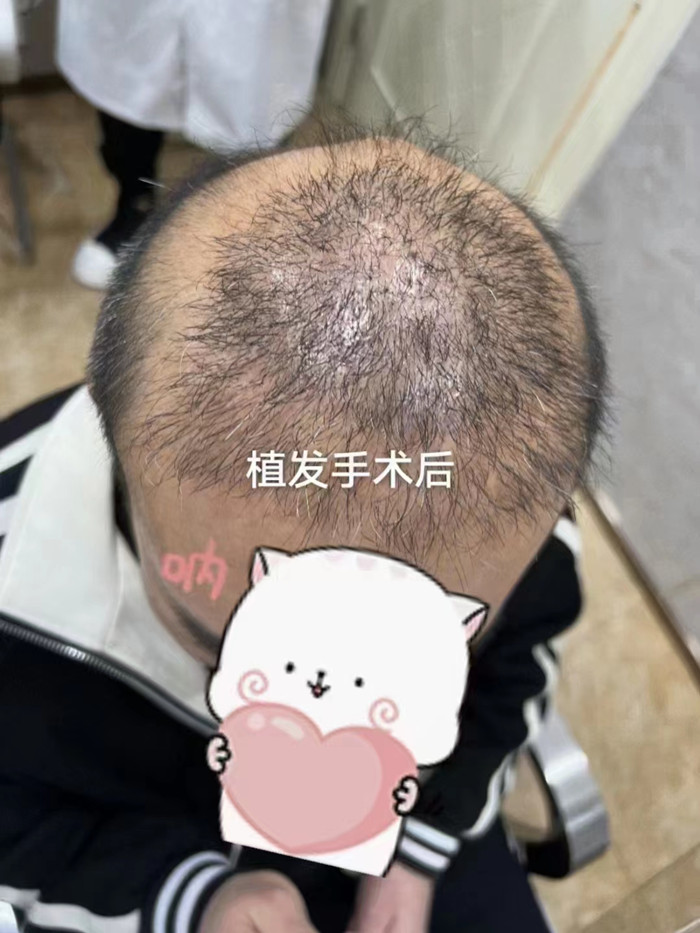脫發(fā)做補發(fā)多少錢 \