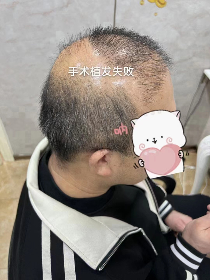 脫發(fā)做補發(fā)多少錢 \