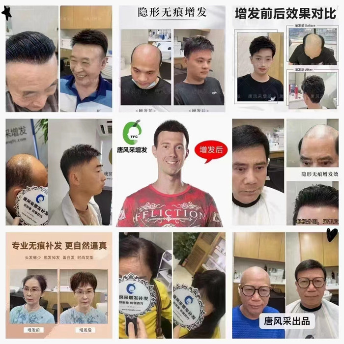 脫發(fā)做補發(fā)多少錢 \