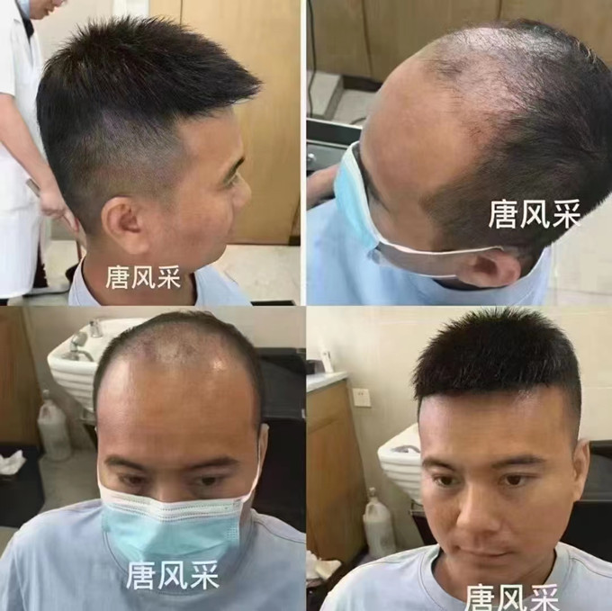 隱形補(bǔ)發(fā) \