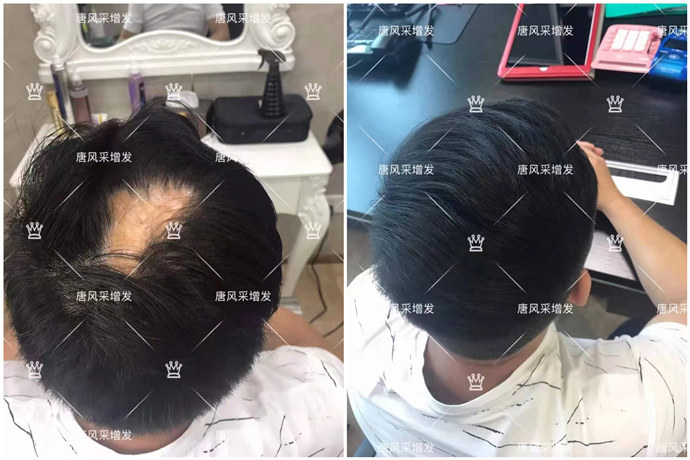 隱形補(bǔ)發(fā) \