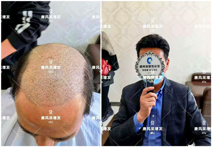 無痕增發(fā) \