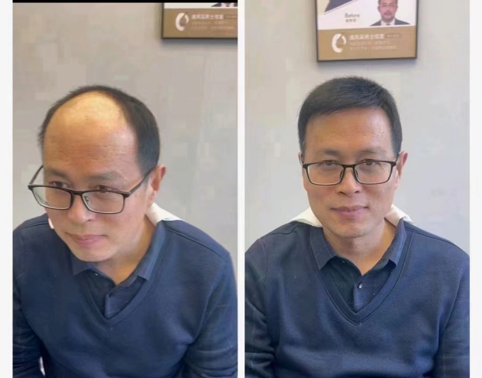 稀疏頭發(fā) \