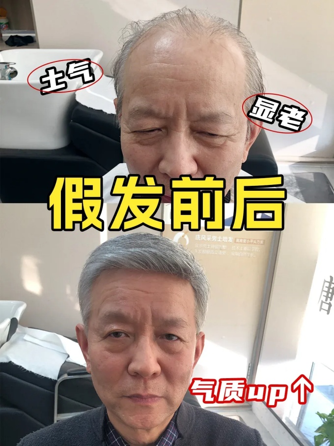 發(fā)量危機(jī) \